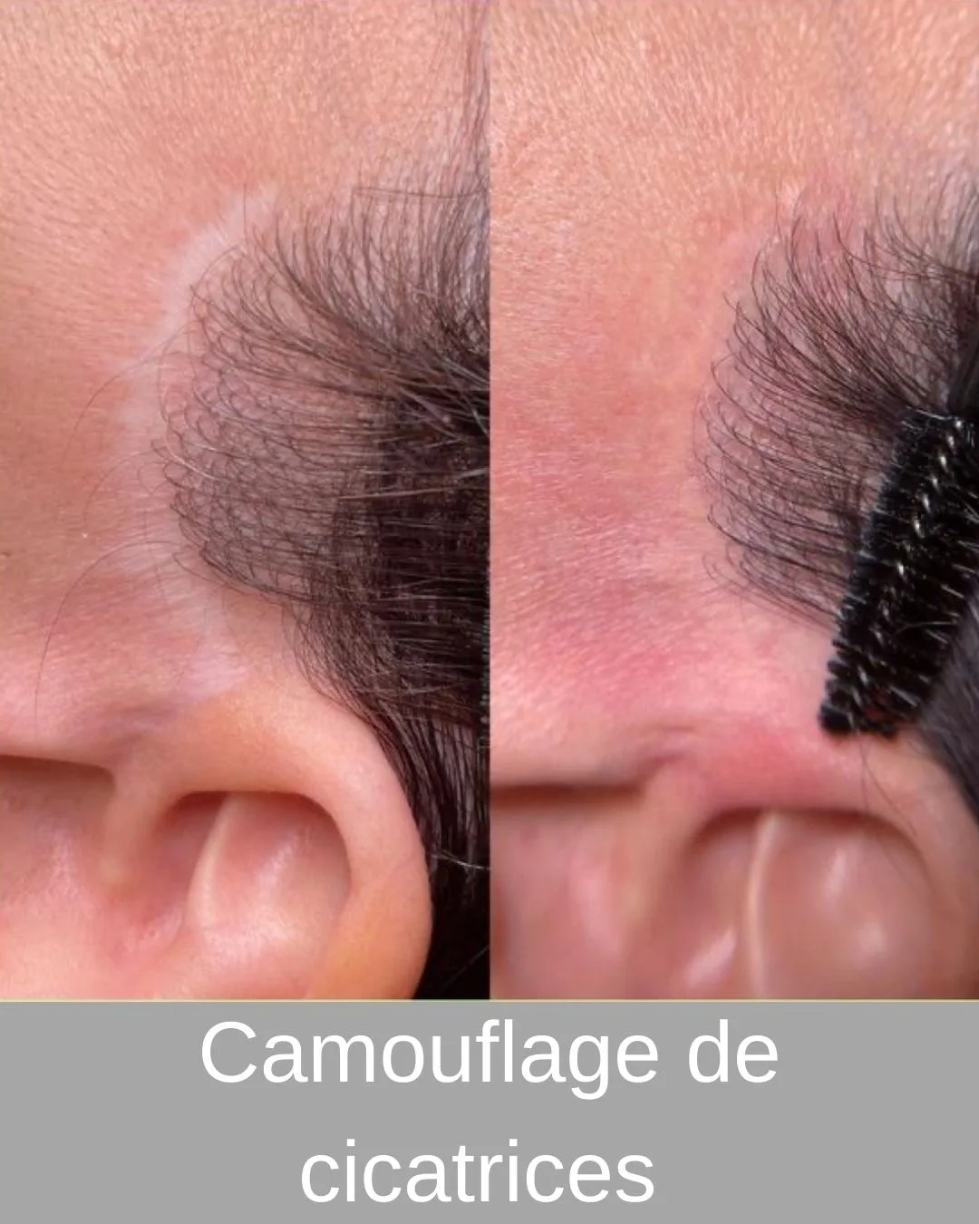 Camouflage cicatrice dermopigmentation Vendée