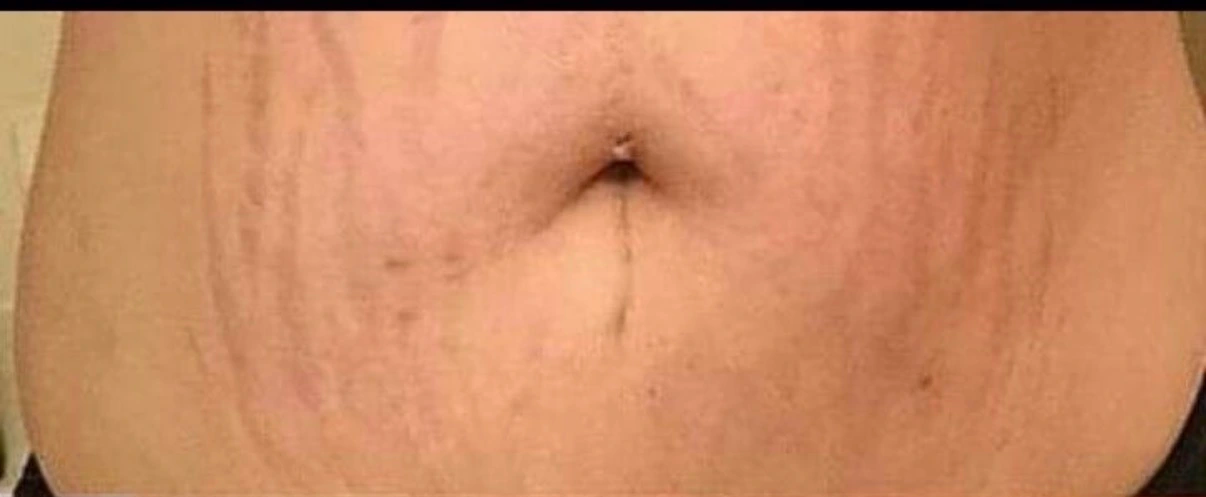 Avant cicatrisation vergeture