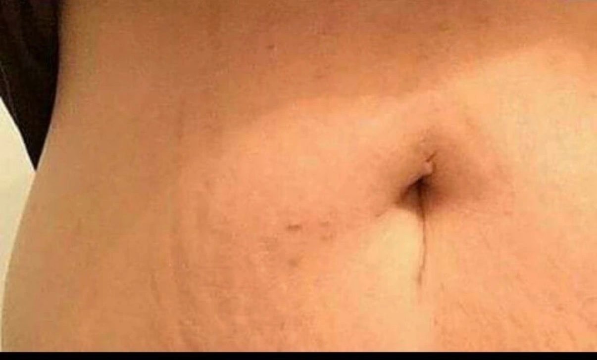 Après cicatrisation vergeture